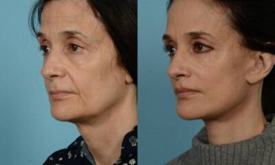 Rejuvenate Your Jawline: The Power of a Lower Facelift