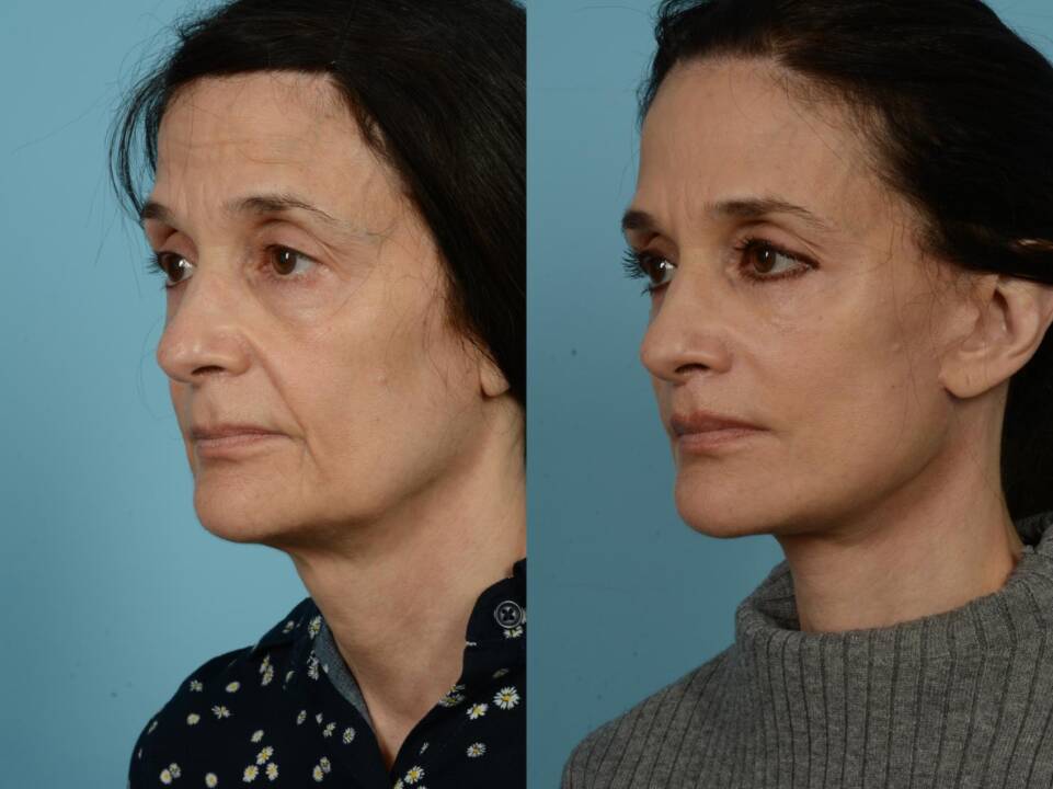 Rejuvenate Your Jawline: The Power of a Lower Facelift