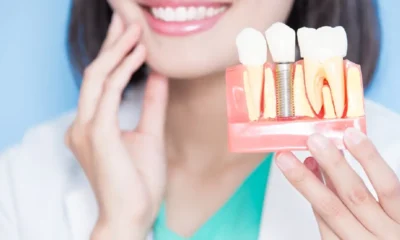 Dental Implants