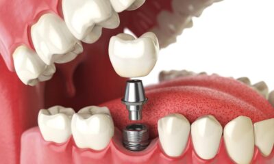 Dental Implants: A Key to Improved Oral Health
