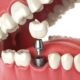 Dental Implants: A Key to Improved Oral Health