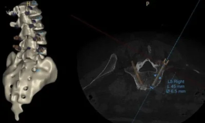 AI’s Impact on Surgical Planning for Spinal Instability