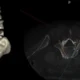 AI’s Impact on Surgical Planning for Spinal Instability