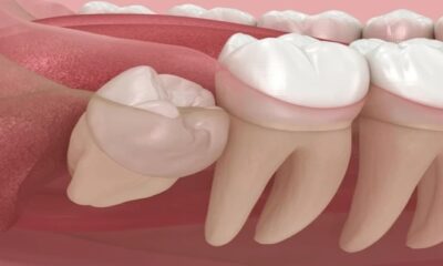 Wisdom Teeth and Jaw Pain: Recognizing the Signs of Impaction