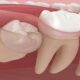 Wisdom Teeth and Jaw Pain: Recognizing the Signs of Impaction