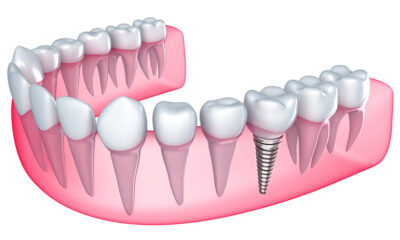 The Comprehensive Guide to Dental Implant Procedures
