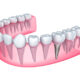 The Comprehensive Guide to Dental Implant Procedures