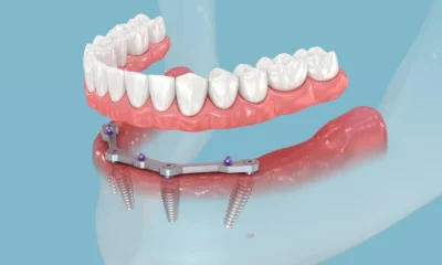 Full Mouth Dental Implants: A Comprehensive Guide to Restoring Your Smile