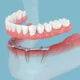 Full Mouth Dental Implants: A Comprehensive Guide to Restoring Your Smile