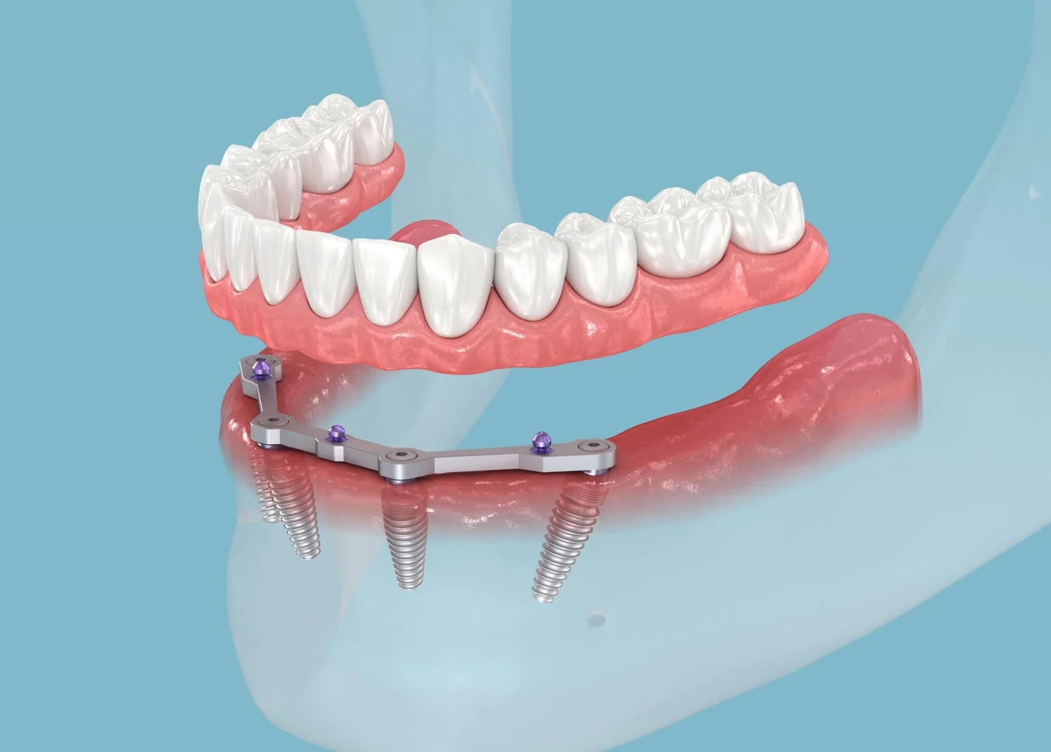 Full Mouth Dental Implants: A Comprehensive Guide to Restoring Your Smile