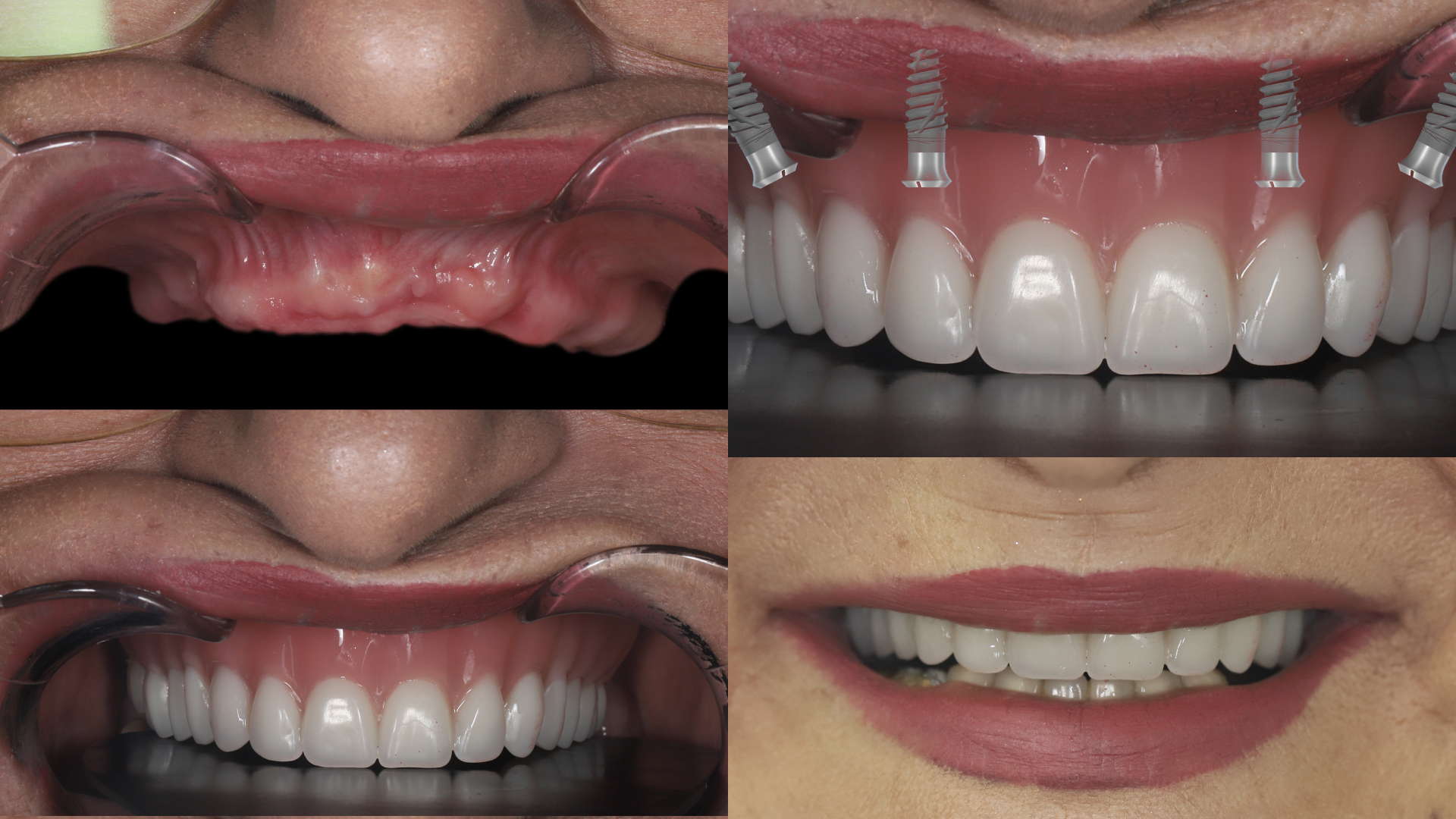 Are Full Mouth Dental Implants Right for You?