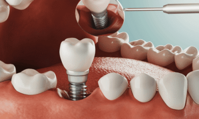 The Long-Term Benefits of Dental Implants for Everyday Life