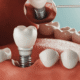 The Long-Term Benefits of Dental Implants for Everyday Life