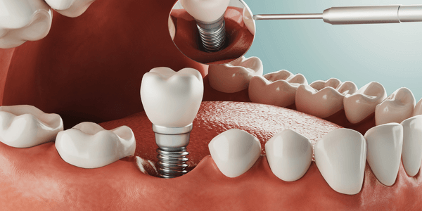 The Long-Term Benefits of Dental Implants for Everyday Life