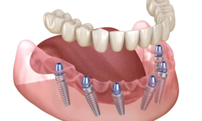 Modern Dental Implant Solutions for Tooth Replacement