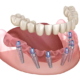Modern Dental Implant Solutions for Tooth Replacement