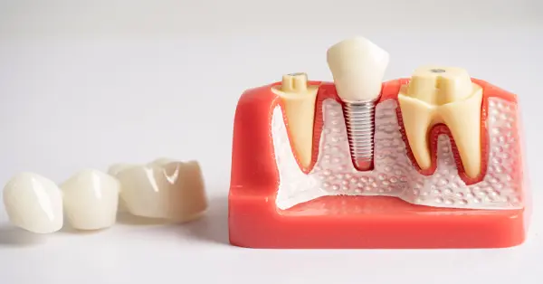 What Makes Dental Implants a Lifelong Solution for Tooth Loss