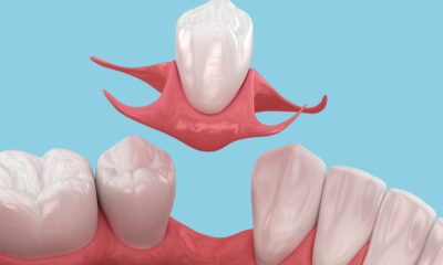 Solutions for Missing Teeth