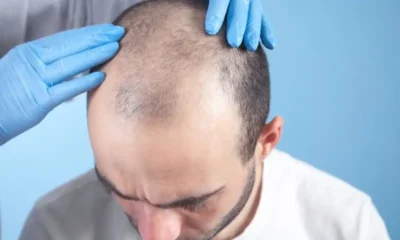 10 Things That Affect How Many Hair Grafts You May Need