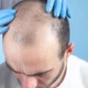 10 Things That Affect How Many Hair Grafts You May Need