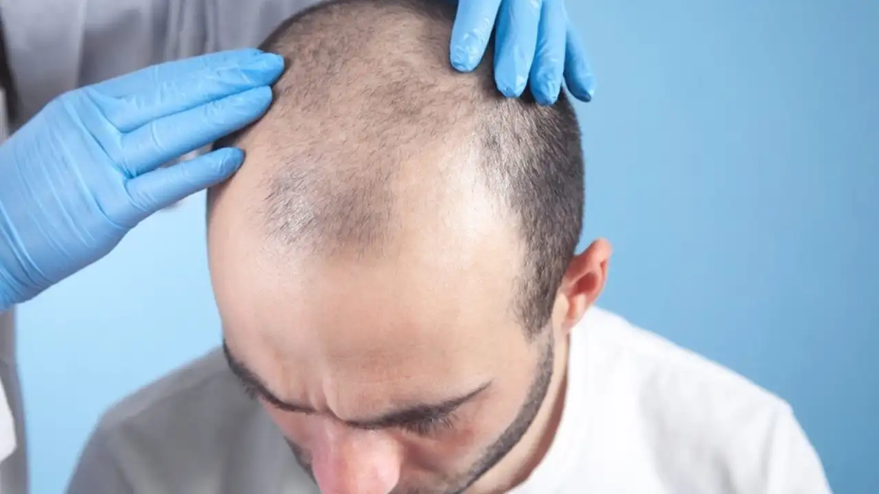 10 Things That Affect How Many Hair Grafts You May Need