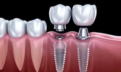 Dental Implants